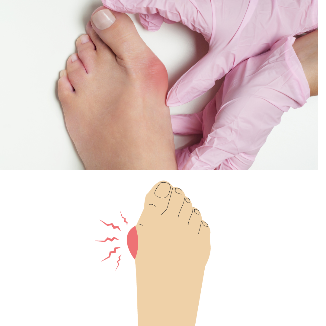 Are bunions genetic?