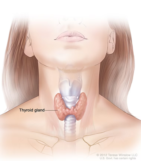 Hypothyroidism: a common endocrine disorder where the thyroid gland does not produce enough thyroid hormone.